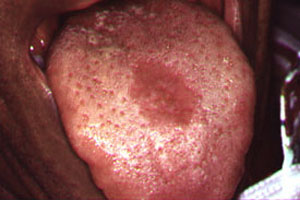 Photo of Atrophic Candidiasis of the Tongue